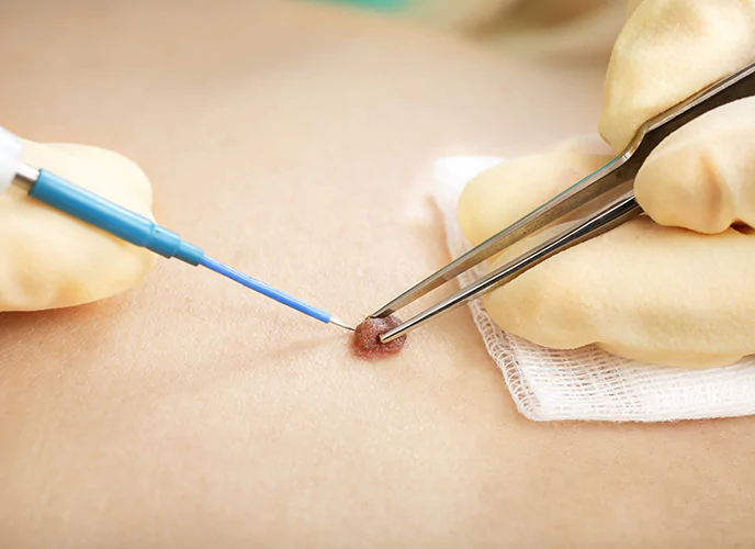 Cirurgia Dermatológica